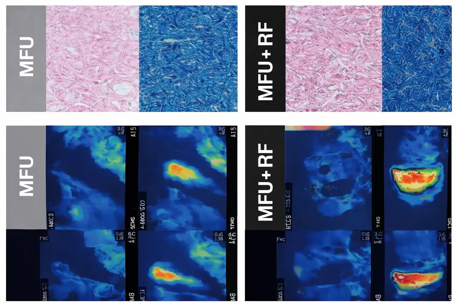 Focus Max 15D Têtes